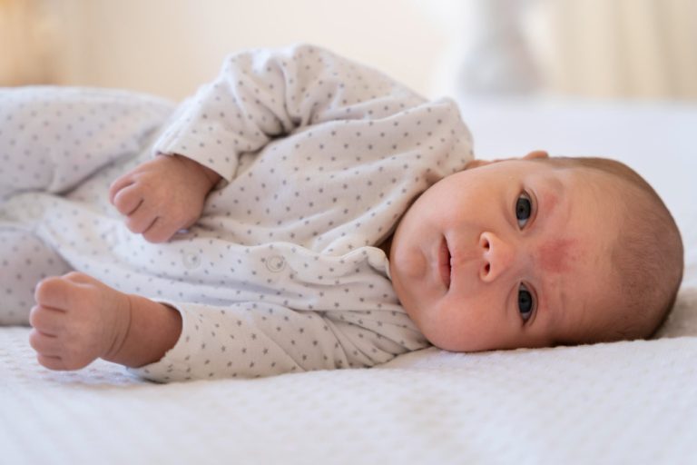 Beruntusan pada bayi